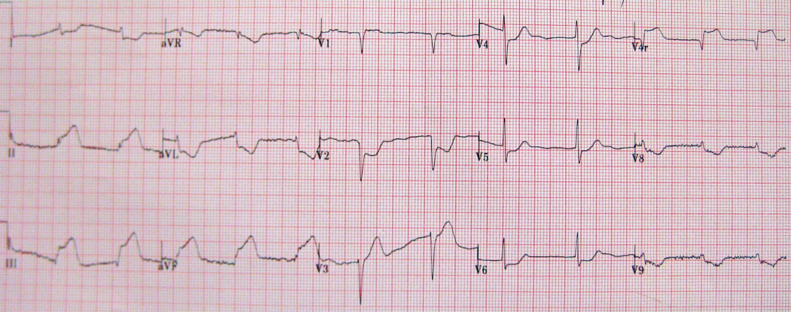 ECG con derivaciones derechas y posteriores. Descripción accesible de hallazgos disponible bajo la imagen.